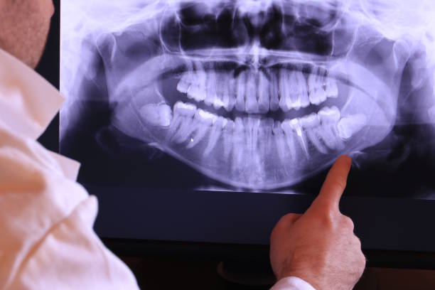 Best Emergency Wisdom Teeth Removal in Hellertown, PA
